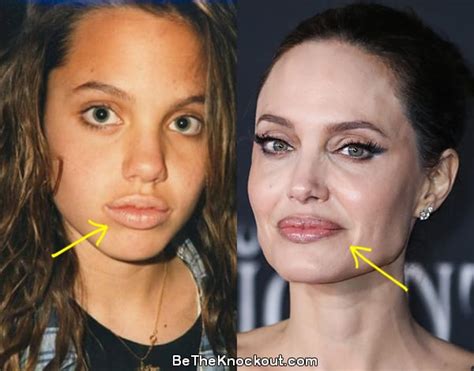 are angelina jolie's lips fake